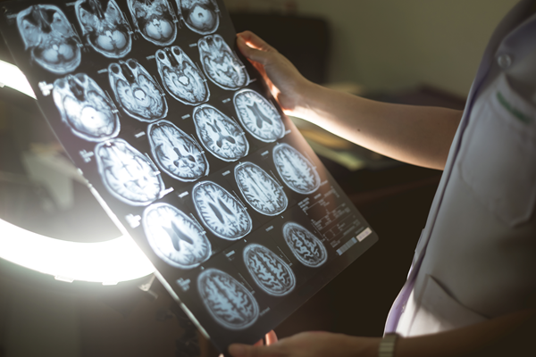 brain scan for dementia