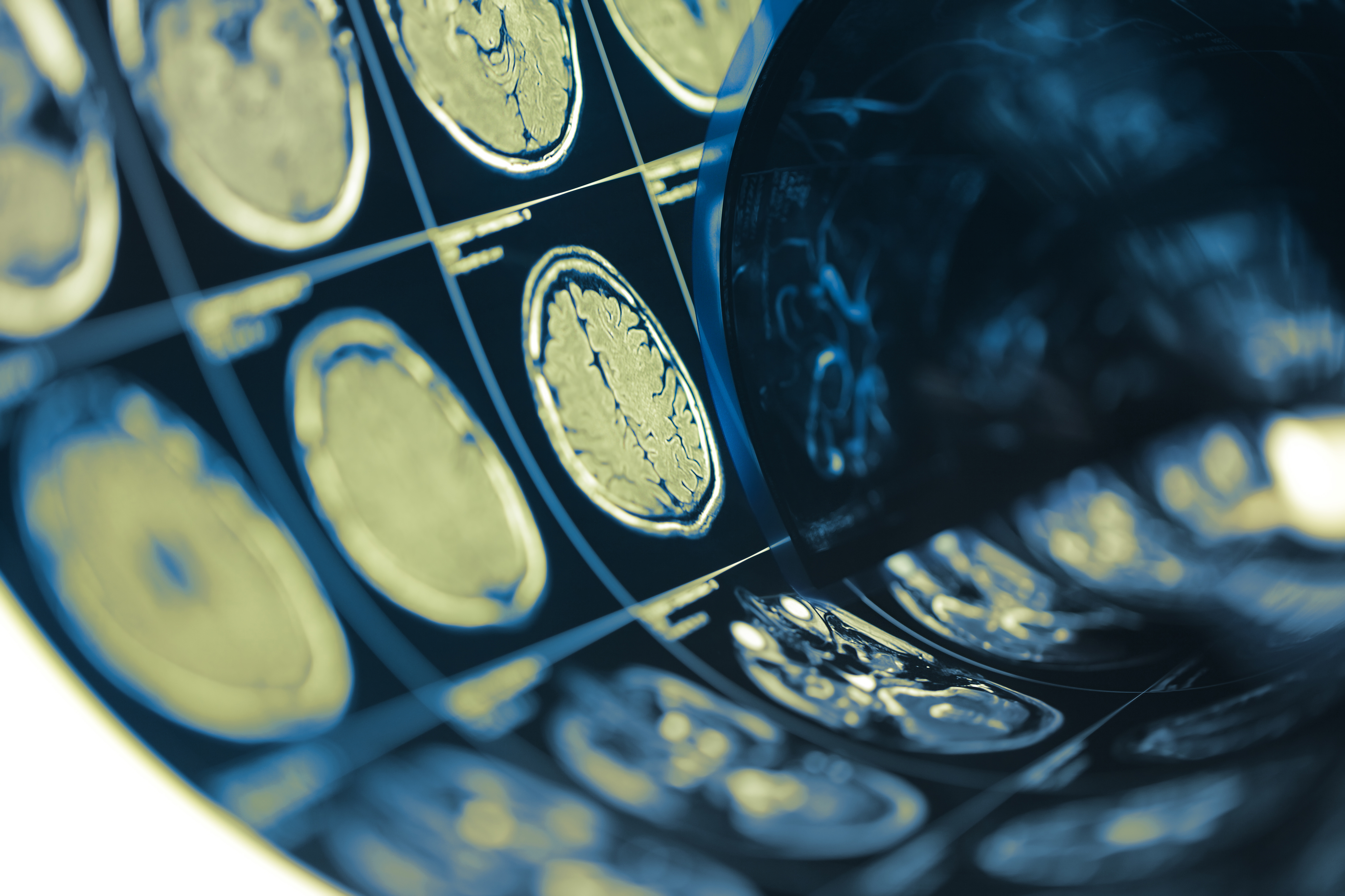 Brain Scans for Concussion
