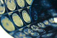 Brain Scans for Concussion